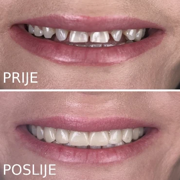 Rekonstrukcija sitnih i razdvojenih zuba u savršen osmeh