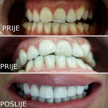 Uklapanje keramičkih faseta sa prirodnim zubima